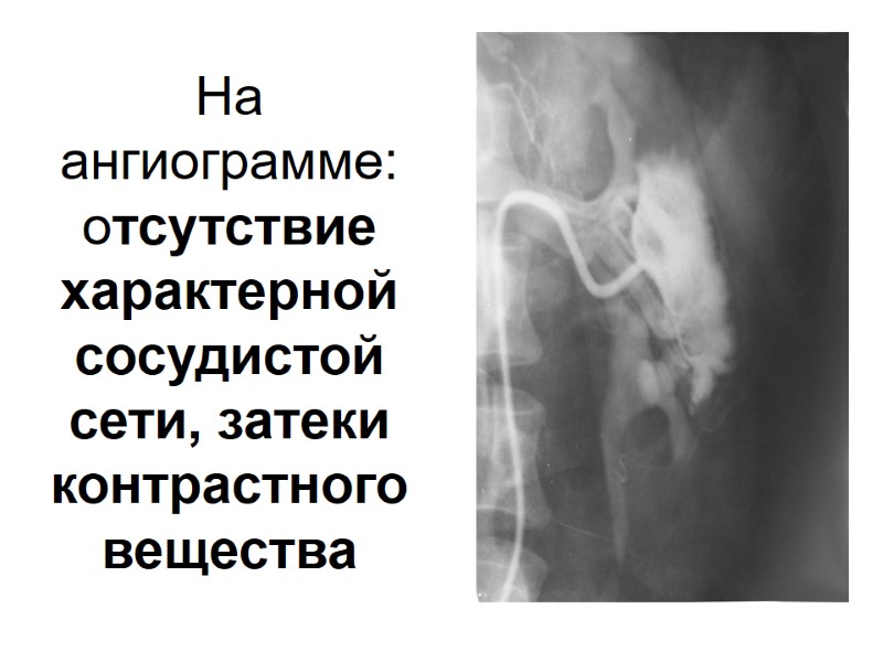 На ангиограмме: отсутствие характерной сосудистой сети, затеки контрастного вещества